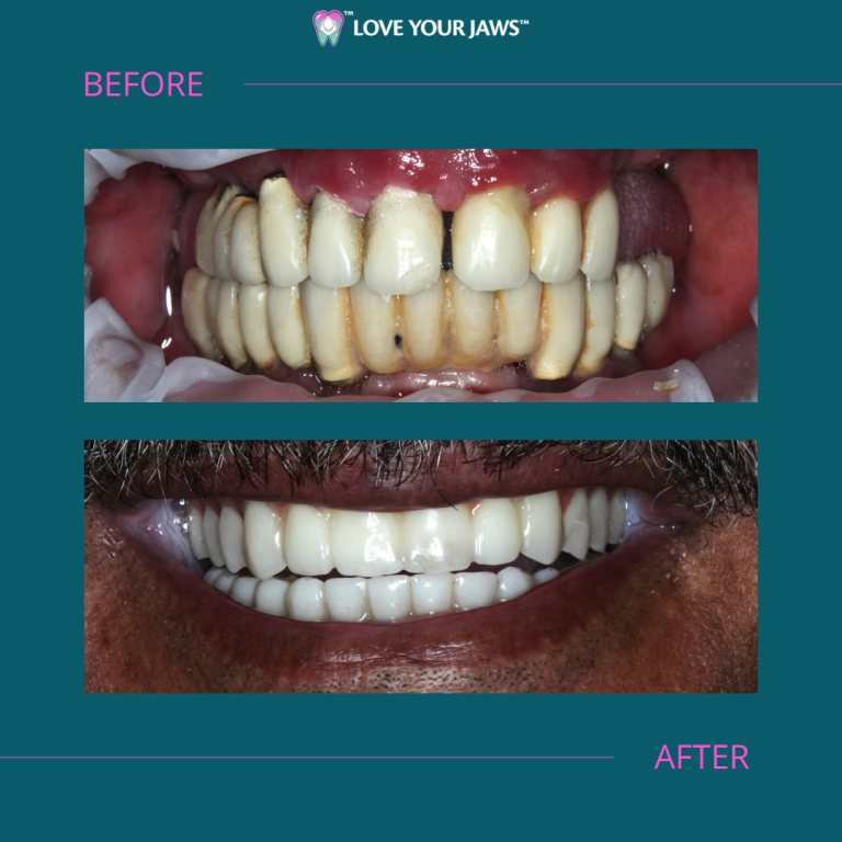 Before and After Dental Implants
