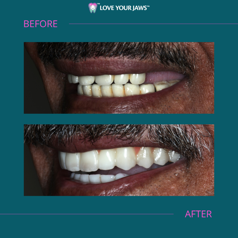 Before and After Dental Implants