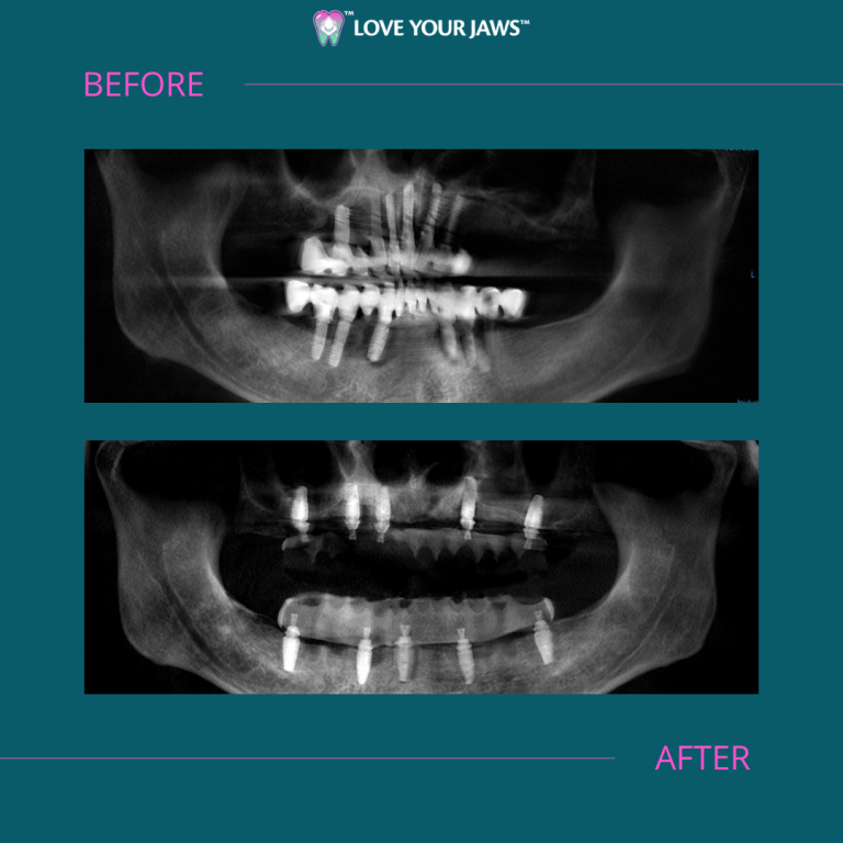 Antes y después de los implantes dentales