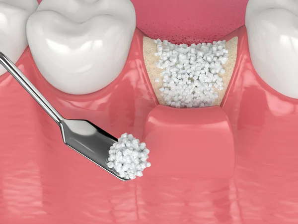 Bone Graft After Tooth Extraction