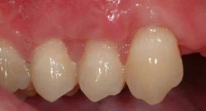 After Periodontal Plastic surgery