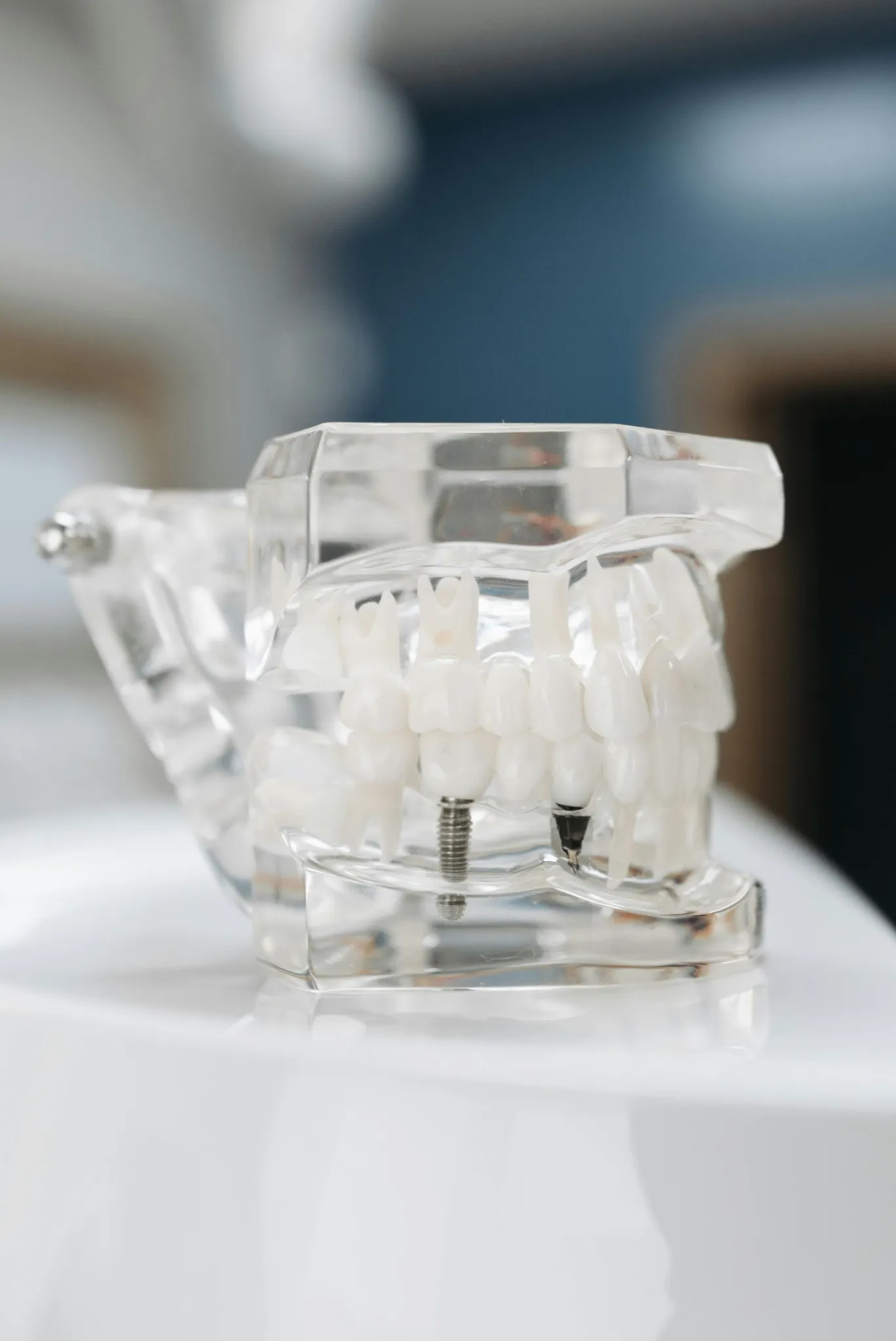 Transform Your Smile with Zygomatic Implants