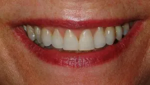 Front view of after Periodontal Plastic surgery