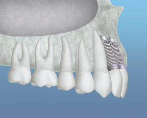 Bone Grafting for Dental Implants
