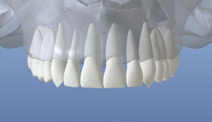 Implantes dentales