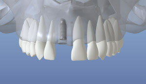 Implantes dentales