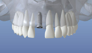 Implantes dentales