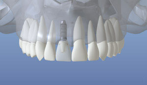 Implantes dentales