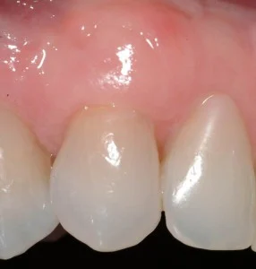 After Periodontal Plastic surgery