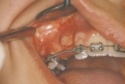 Impacted Cuspid