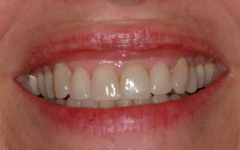 Vista frontal completa después de cirugía plástica periodontal para restaurar las encías