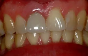Vista completa de los dientes del paciente antes del tratamiento de cirugía de implantes