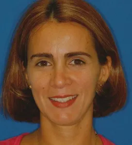 Resultados completados después de cirugía de implantes para paciente femenina