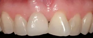 Posicionamiento invertido de los dos dientes frontales