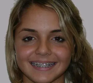 Antes con ortodoncia