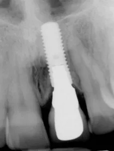 Radiografía de procedimiento de implante dental único