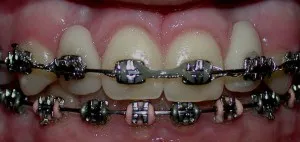 Antes con ortodoncia con pérdida de encía visible