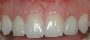 Después de retirar la ortodoncia y restauración de encía 