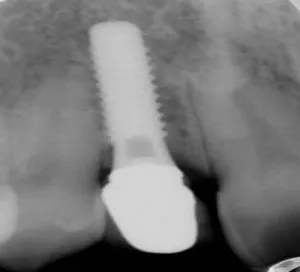 Ejemplo de cirugía de implantes completada, vista radiográfica