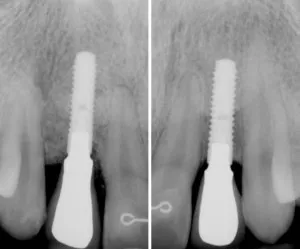 Dos imágenes radiográficas del éxito de cirugía de implante de diente único