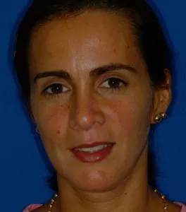 Imagen posterior del paciente una vez retirada la ortodoncia