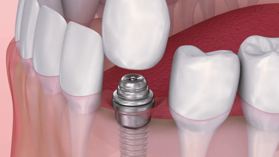 Before and After Dental Implants