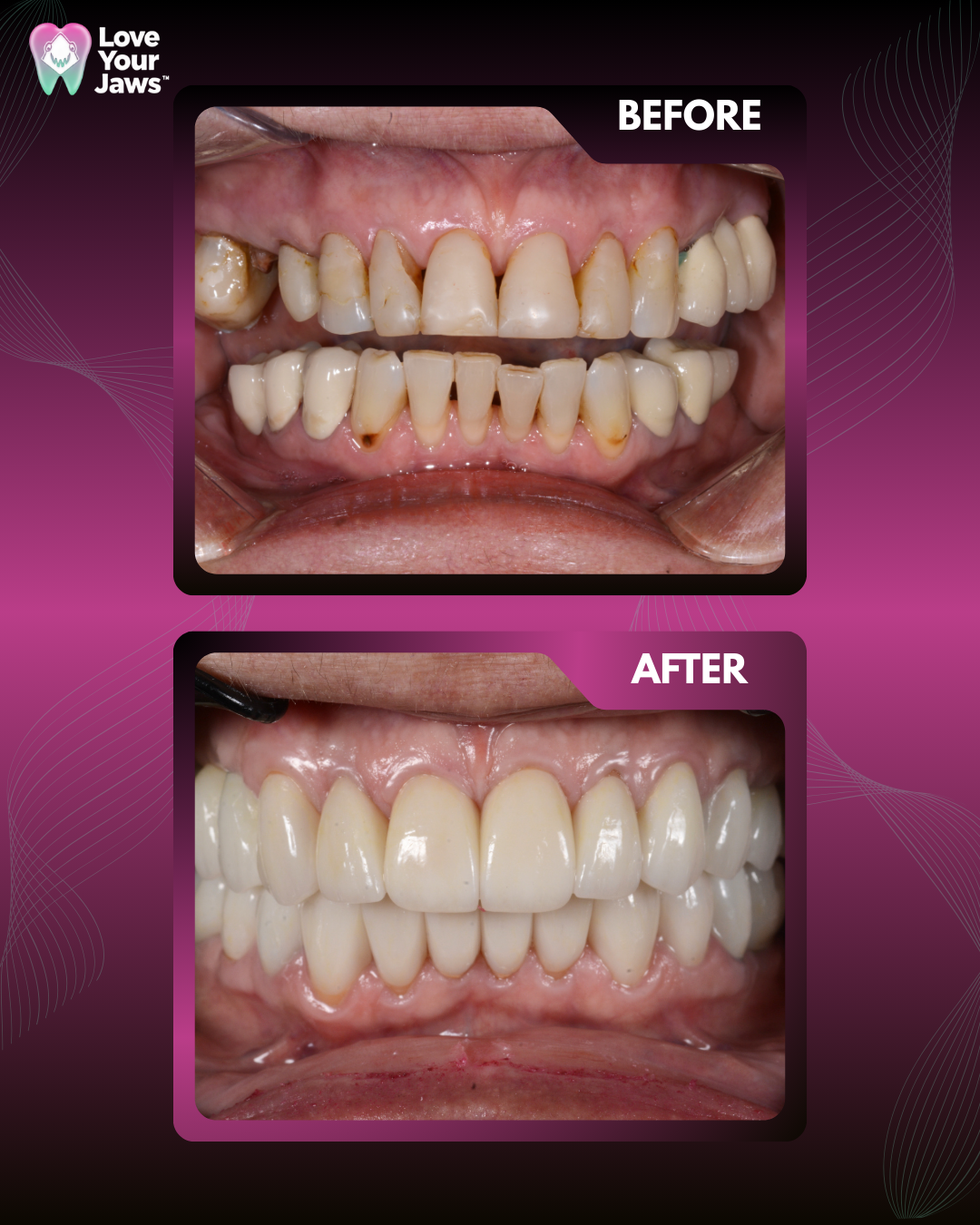 Comparison of a patient's smile before and after a dental procedure; the bottom image shows a bright, symmetrical, and white smile following advanced restorative dental treatment.