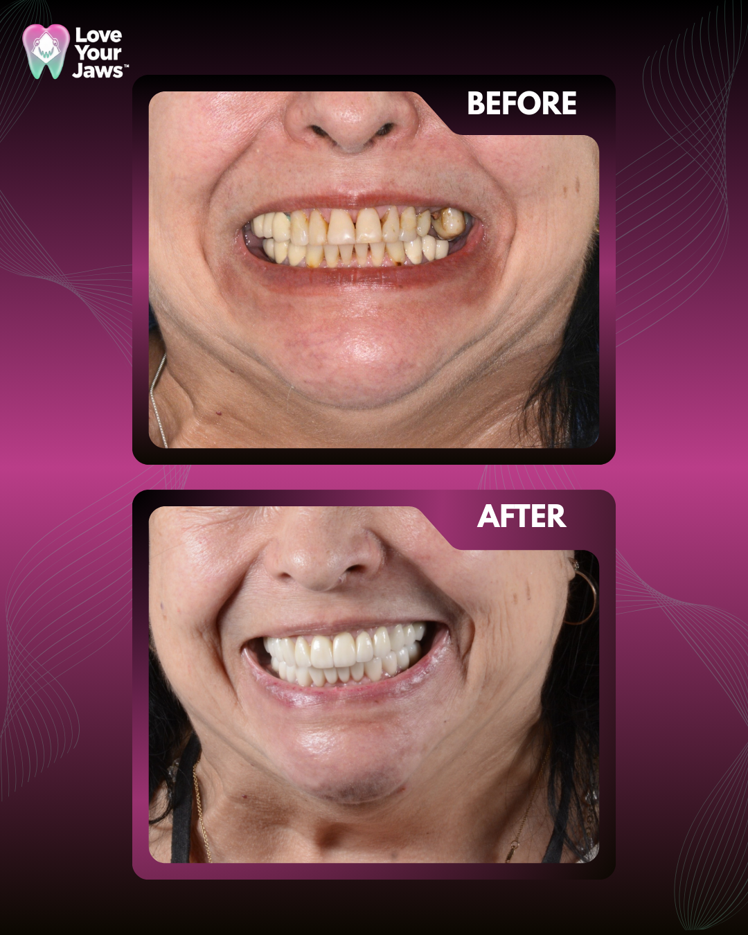 Before and after photos of a full mouth dental reconstruction showing a transition from worn, yellowed teeth to a bright, uniform, and healthy smile with professional dental implants.