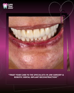 A close-up photograph of a patient's healthy, vibrant smile featuring a full set of upper dental implants, presented in a professional marketing frame. The image is bordered by a deep magenta and black gradient background. The "Love Your Jaws" logo, featuring a stylized tooth with a heart, is in the top-left corner, and a delicate white line-art heart with a paperclip icon is in the top-right. White text at the bottom reads: "TRUST YOUR CARE TO THE SPECIALISTS IN JAW SURGERY & ROBOTIC DENTAL IMPLANT RECONSTRUCTION™".