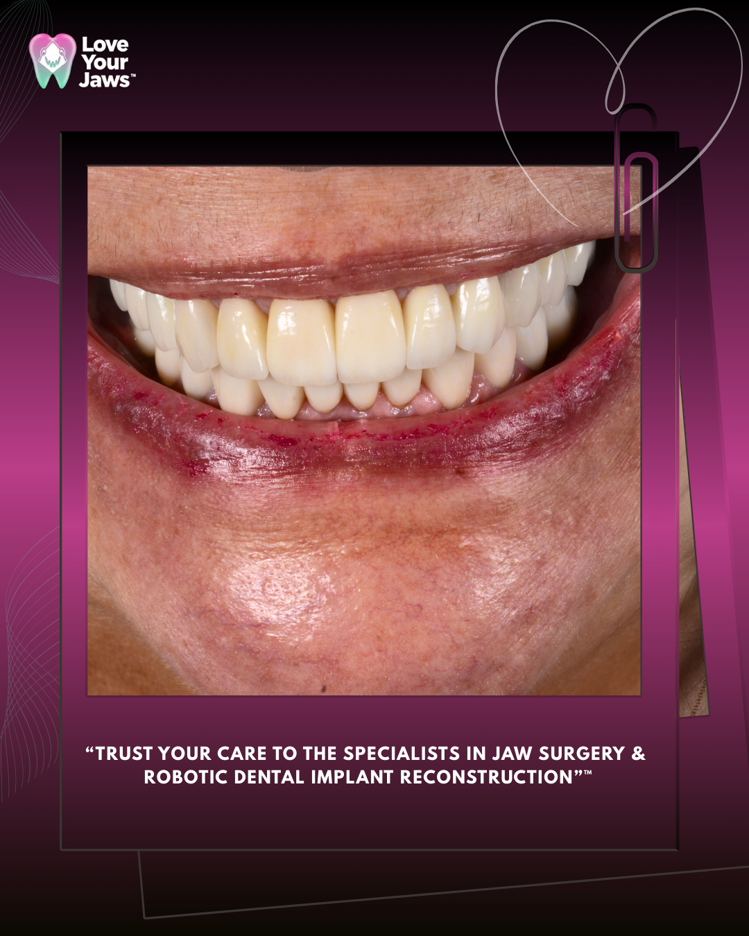 Restore Your Smile with Dental Implants at Love Your Jaws Surgery Center