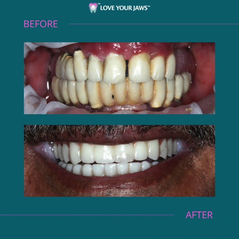 Antes y después de los implantes dentales