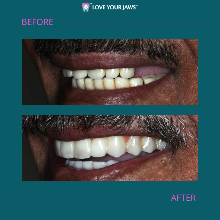 Antes y después de los implantes dentales