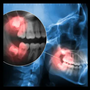 Why is it important to remove wisdom teeth?