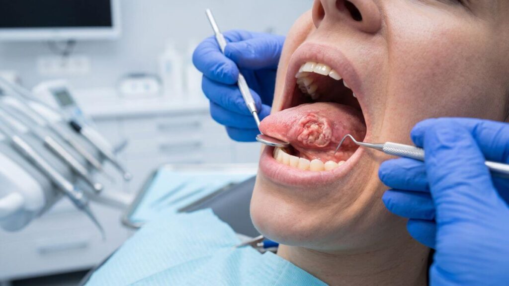 Medical photo showing blue gloved hands examining an irregular ulcerated lesion on the tongue, consistent with oral squamous cell carcinoma.