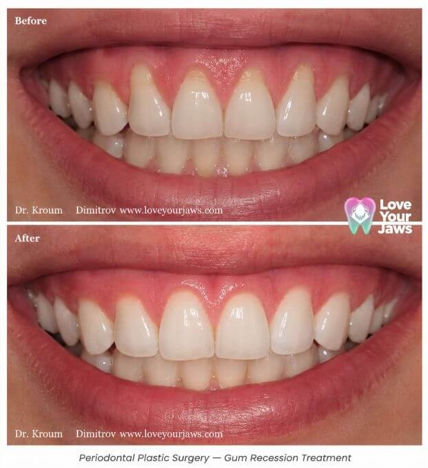 Before and after periodontal plastic surgery demonstrating advanced gum grafting for gingival recession, root coverage, improved gum health, natural smile aesthetics, and periodontal tissue regeneration by an oral and maxillofacial surgeon.