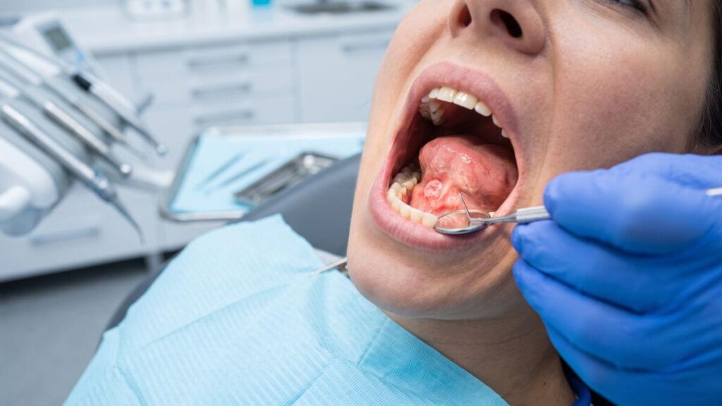 Close-up of oral cancer screening in South Miami, examining the floor of the mouth with a mirror.