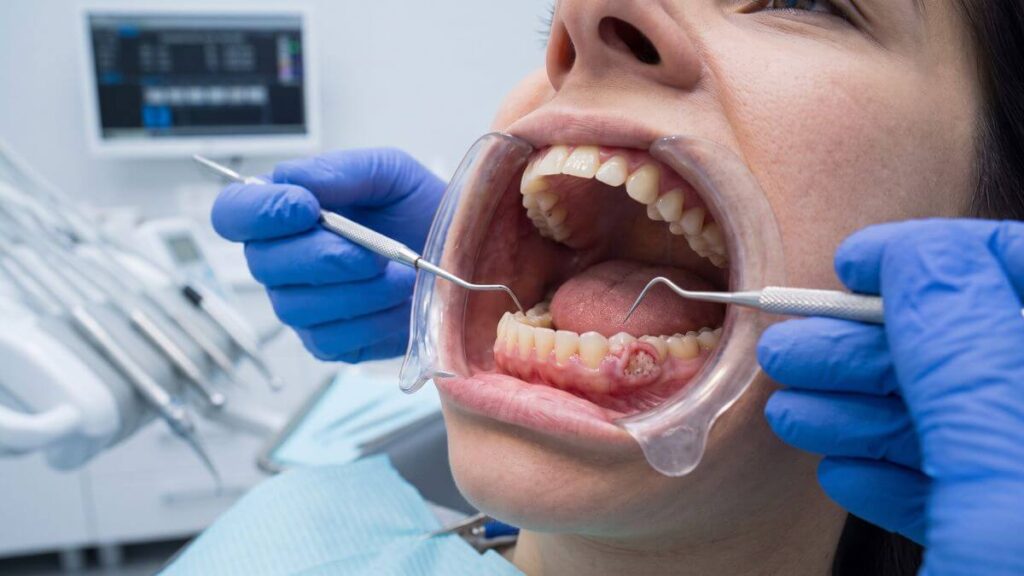 Close-up of a dentist using tools to examine a prominent reddish-white ulcerated lesion on a patient's lower right gum line.