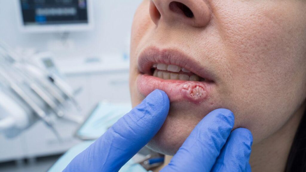 Close-up of blue-gloved hands carefully palpating and examining a crusted reddish-white lesion on a patient's lower lip.