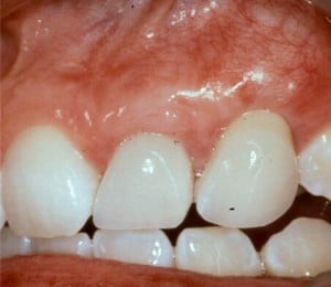 After Periodontal Plastic surgery
