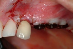 View of inserted screws for periodontal plastic surgery