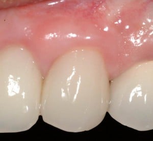 Completed results of surgery for implants