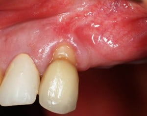 Exposed tooth before periodontal plastic surgery