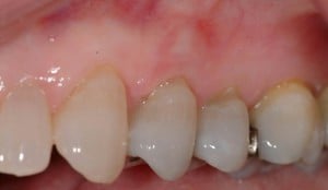 After periodontal plastic surgery to restore gums