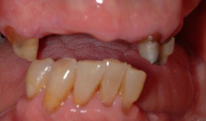 Before All on 4 procedimiento, missing teeth