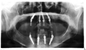 X-ray display of all on 4 procedimiento