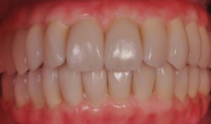 After photo of all on 4 procedimiento 